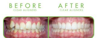 Before & after image of clear aligners