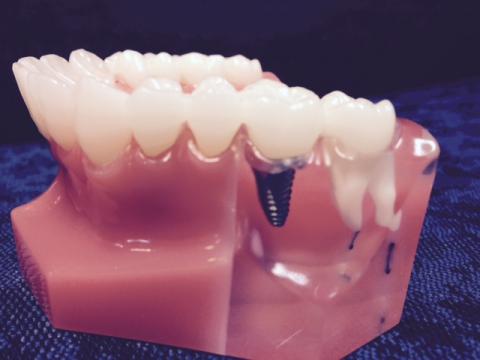 Dental bridge