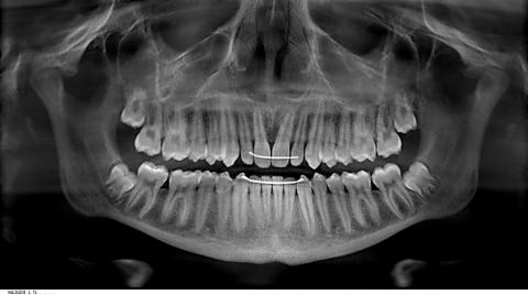 X-ray of teeth