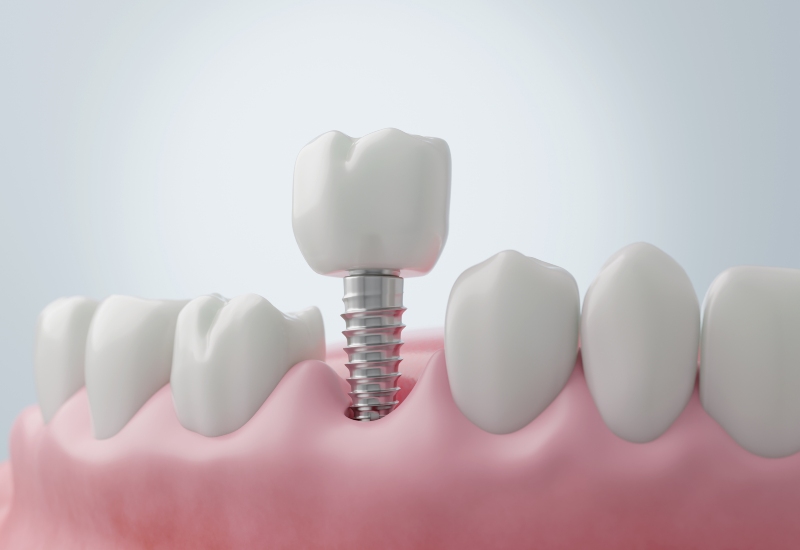 A 3D illustration of a dental implant system showing crown, abutment, and gum tissue in Kenosha, WI