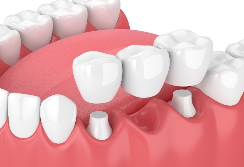 3D dental bridge illustration showing tooth replacement treatment in a dental office in Kenosha, WI