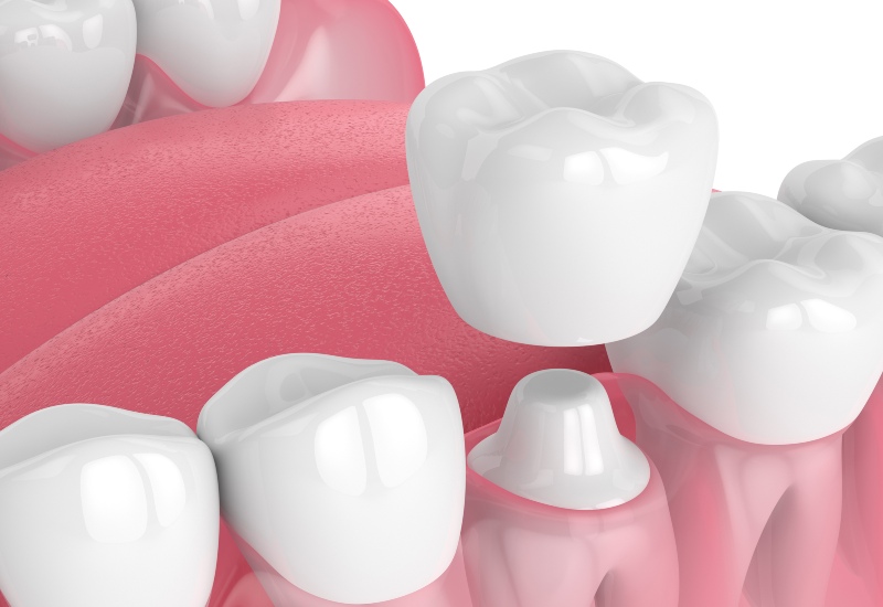 3D dental crown and filling illustration showing tooth restoration in Kenosha, WI
